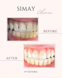 عيادات سيماي • تسوس بجلسة • ميسان عواشة