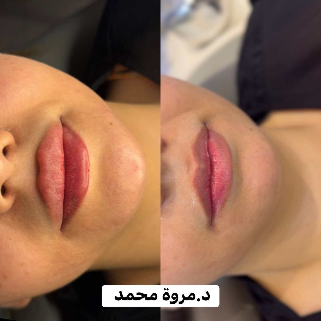 جمال حقن الشفه والذقن واعادة تنسيق ملامح الوجه ❤️🫰🏻

عيادة الدكتورة مروة محمد التميمي

🏥الديوانية العروبة-شارع المتحف-مجاور مطعم كودو كودو
📞رقم الحجز ***********

متوفر نظام التقسيط على الماستر كارد
