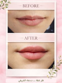 فيلر شفايف • دكتورة دعاء الشريفي • كربلاء شارع الجمهورية