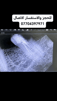 اعاده حشوه جذر باحدث الاجهزه بعد فشل الحشوه السابقه
انقاذ السن م̷ـــِْن القلع بحشوه جذر بطريقه متقنه وصحيحه
احجز موعدك اليوم وخلي ابتسامتك تحجي عنك بكل أناقة 😁✨
☎️ للحجز والاستفسار:
📞 ***********
📍 موقع العيادة:
📌 الدولعي داخل سوق الدولعي ثاني فرع ع اليمين
