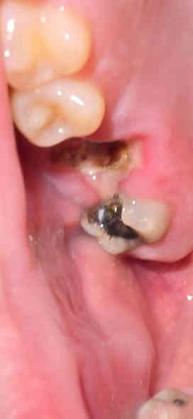 السلام عليكم 
اللي عنده مثل هاي الحالات او اي مشاكل ثانية خلي يتفضل خاص او يتواصل على الرقم ***********
علما بانه العلاج مجاني في جامعة العين
