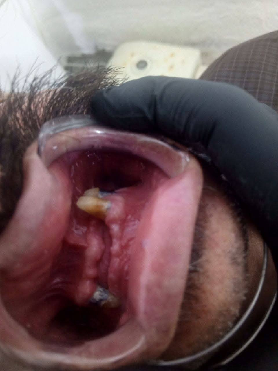 مسابقه -مسابقه- مسابقه 

الكثر شخص متفاعل بعيادتنا يفوز ويانا
شروط المسابقه كلش سهله

1-لايك
2-اكثر شخص يسوي تاكات للاصدقاء
ومتفاعل بلحساب
3-مشاركت المنشور باكثر م̷ـــِْن كروب
4-متابعة الحساب 

الجوائز 🎁🎁🎁🎁

1-تنظيف vip
2-تقويم اسنان
3-تغليف اسنان زاركون 
4-حشوة تجميلية

يتم علان الفائز اول يوم العيد 

المكان/ حي 17 الشارع العام لمكتبة المهندس مجاور لمدرسة المشاعل
للحجز والاستفسار/ ***********

هاي الحاله طقم اسنان متحرك في عيادتنا لمراجع كان يعاني من تقدم في الفك الاسفل ومشاكل في الأطباق 
وهاية النتيجة النهائية بعد تصحيح الاطباق 🔥
