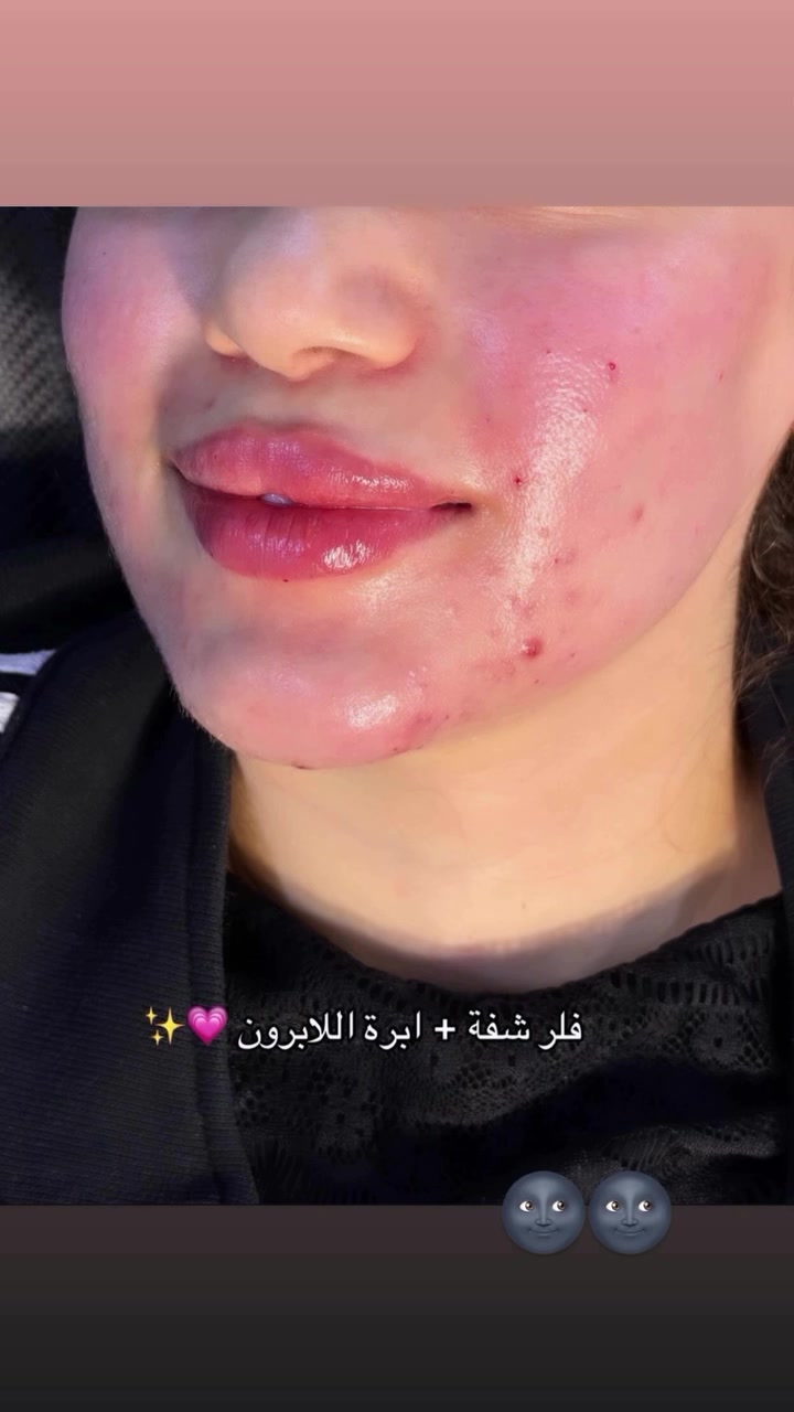 حبايب قلبي عروض نضاره الوجه + ابر ترطيب + ابر تفتيح للتواصل ***********

