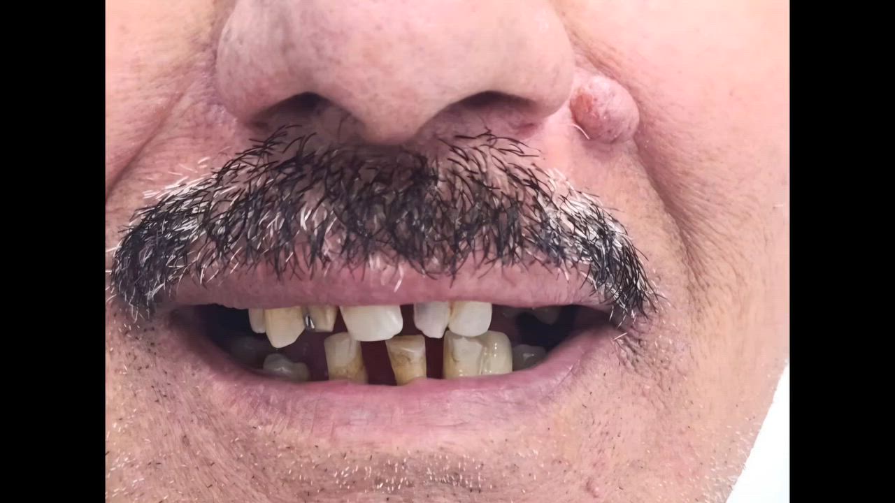 لا مساومة على الجودة في مركز الوارث؛ نستخدم أرقى الخامات العالمية لنصنع تيجاناً وجسوراً تجمع بين صلابة الأداء وعفوية المظهر الطبيعي
من اعمال طبيبنا المتميز🫡
د محمد السخي
📍 متواجدين يومياً طول أيام الأسبوع:
⏰ من الـ9 الصبح للـ12 الظهر
⏰ ومن الـ2:30 العصر للـ9:30 بالليل

📞 للتواصل ويانه:
✅ العيادات البشرية: ‎***********
✅ عيادات التجميل: ‎***********
✅ عيادات الأسنان: ‎***********

📍 العنوان: الناصرية – شارع بغداد، مجاور مدرسة الجواهري الأهلية
