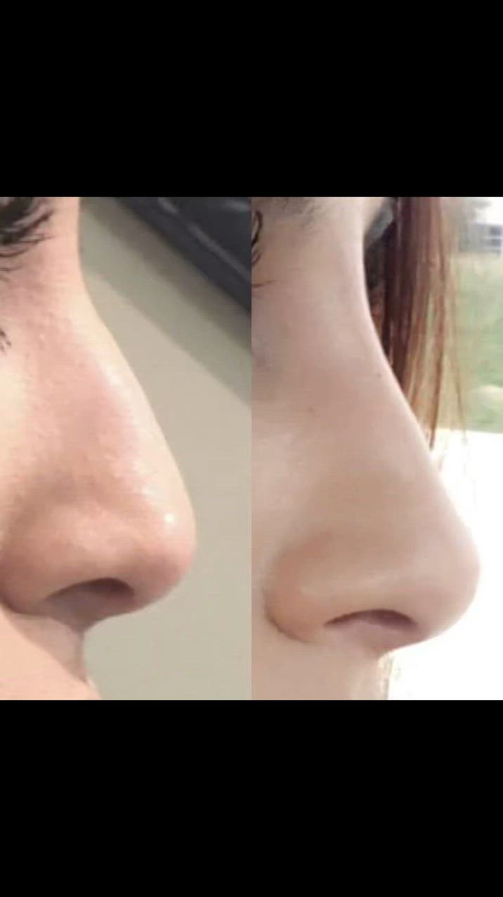 معه سيروم وتقويم لأنف 
الحل لاسهل لحصول ع انف جميل من دون عمليه تجميل 
حل سهل وأمن  لطلب خاص
# عناية #ريلز #اكسبلور


**إذا كنت صاحب هذا الإعلان وتريد حذفه لأي سبب، رجاءا أرسل رسالة إلى الدعم الفني**
