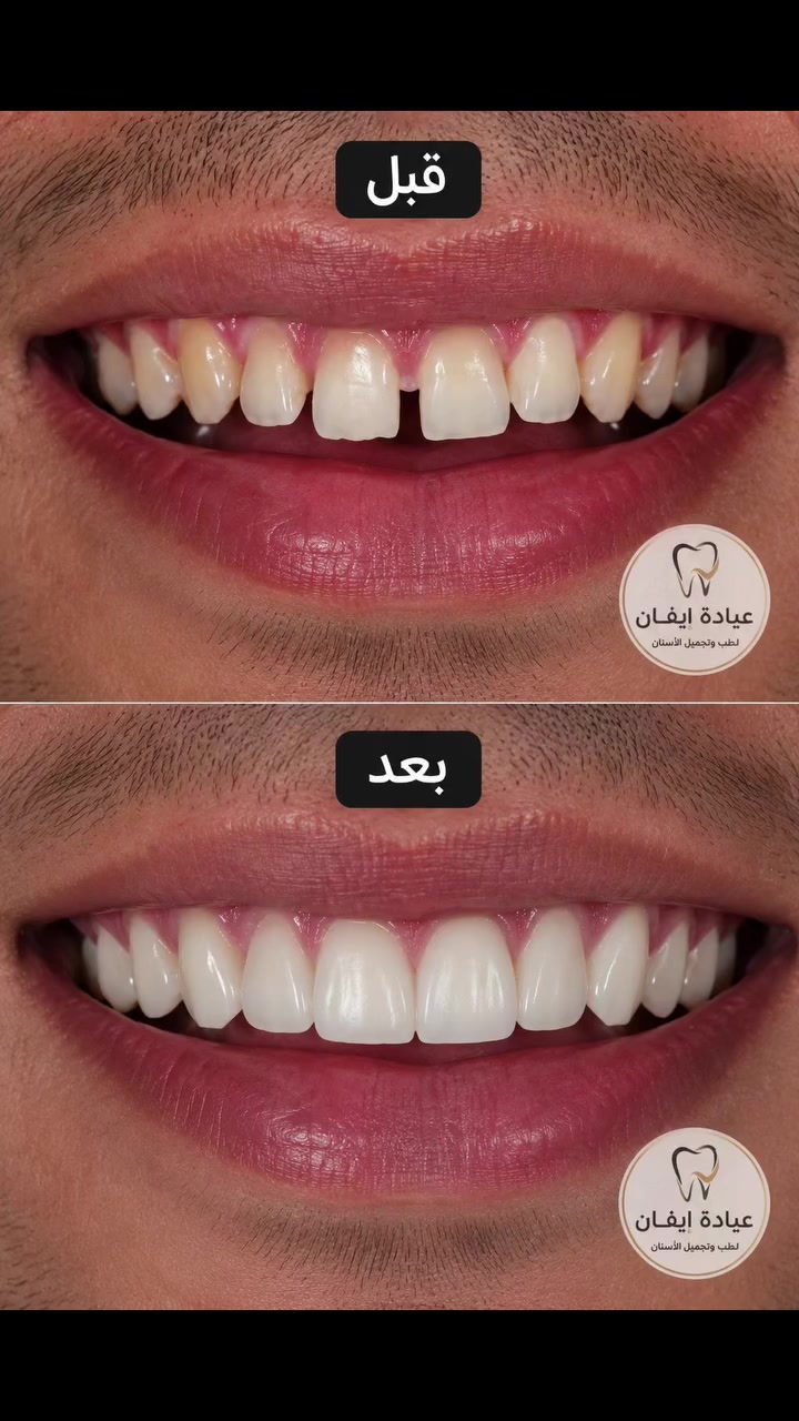 لكتابة
✨ عمل حشوات تجميلية في عيادة إيڤان لطب وتجميل الأسنان ✨
🦷 مظهر طبيعي مطابق للون الأسنان
🦷 نتائج فورية في جلسة واحدة حسب الحالة
🦷 مواد عالية الجودة
🦷 بإشراف طبي وبأسعار تنافسية
📍 البصرة – قضاء الدير – ناحية النشوه (مقابل دائرة النفوس)
📞 للحجز والاستفسار: ***********
