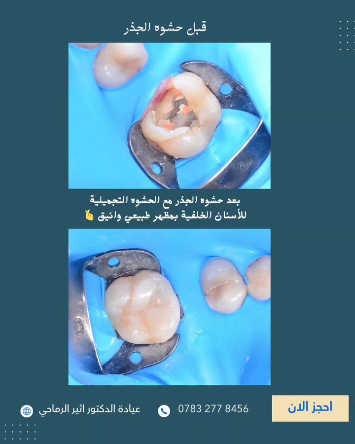 “بإتقان واهتمام بالتفاصيل "
تم ترميم الأسنان الخلفية بحشوة جذر وحشوة تجميلية لاستعادة كفاءتها ومظهرها الطبيعي.” ✨

 (عيادة الدكتور أثير حليم الرماحي) 

☎️ للحجز والاستفسار ***********
او مراسلة الصفحة

📍 الموقع: 
الديوانية- قضاء عفك/شارع الأطباء قرب صيدلية أكرم البديري بناية الدكتورة مروة حمود التميمي الطابق الثاني

#ابتسامتك_تستحق_الأفضل #دکتور_اسنان
#حشوات_تجميلية_حشوات_جذور_تركيب_اسنان_ثابتة_ومتحركة_تبييض_اسنان_بالليزر_ابتسامة_المشاهير
#قضاء_عفك #اكسبلورexplore
