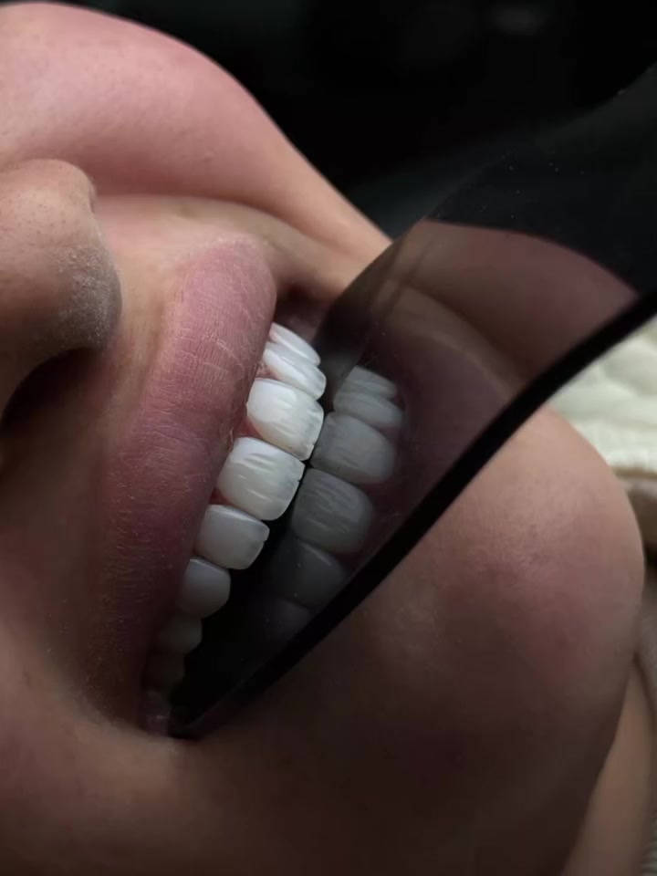 غيّر ابتسامتك... وغيّر انطباعك.🤍✨
متواجدين طيلة أيام الأسبوع 
العنوان/القرنة/شارع المستوصف/عمارة شركة بغداد للحاسبات/للأستسفار/***********
 #الشركة الطبية العالمية
