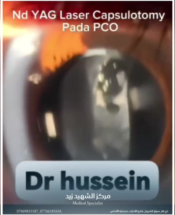 الجهاز الوحيد في سوق الشيوخ بمركز الشهيد زيد حميد الطبي 
 (ياك ليزر) YAQ Laser

✨ تنظيف العدسة بعد عملية سحب الماء الأبيض

يُعد YAQ Laser (ياك ليزر ) إجراءً سريعًا وغير جراحي، ويستغرق بضع دقائق فقط.

✅ غير مؤلم
✅ لا يحتاج إلى تخدير، فقط قطرات مخدرة للعين
✅ يستطيع المريض العودة إلى نشاطه الطبيعي بسرعة
✅ يُستخدم لتنظيف العدسة بعد عملية سحب الماء الأبيض واستعادة وضوح الرؤية عند حدوث عتامة في المحفظة الخلفية

الدكتور صالح يوسف الحسين
اختصاص بورد في جراحة العيون، وتجميل العين، وجراحة قص الأجفان

***********
