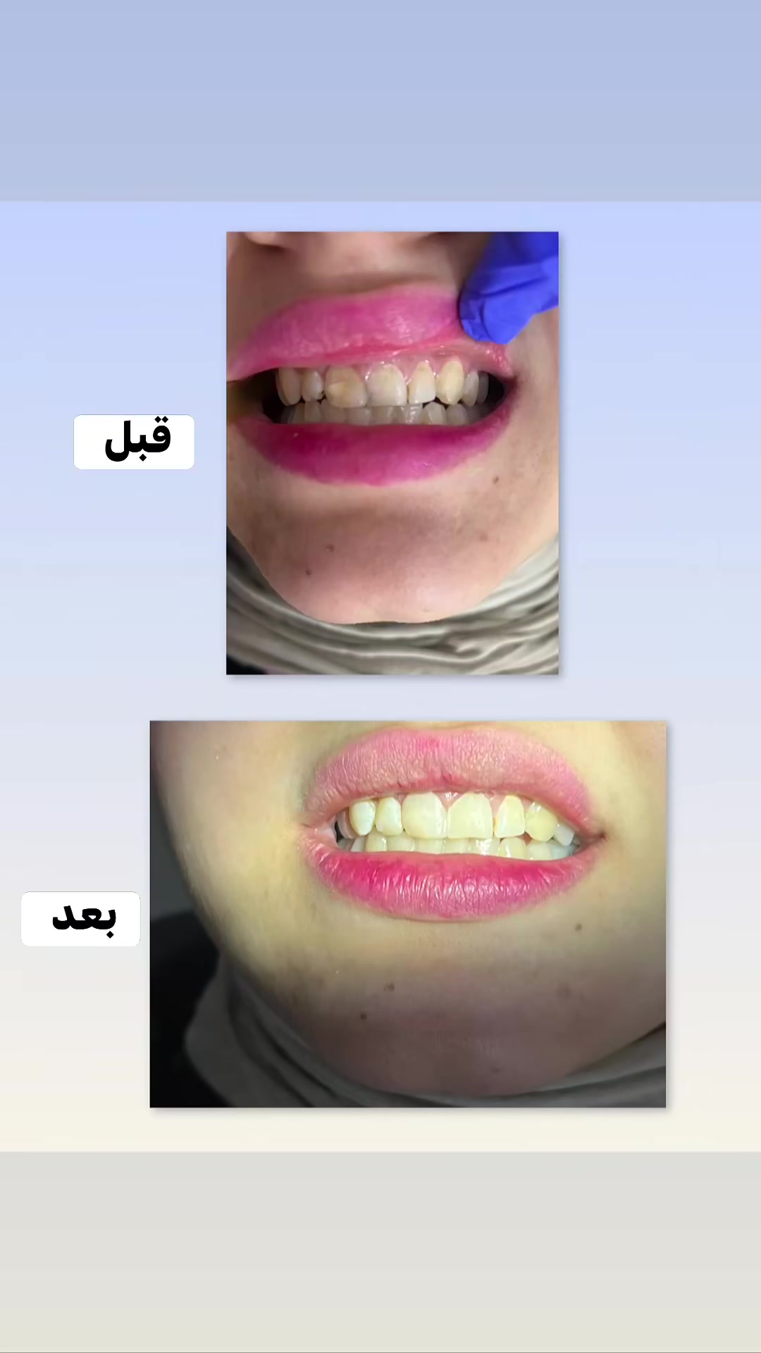 “اختيارك للمكان الصح دليل حرصك على صحتك 🌟🤷🏻‍♀️🦷 
مع د . حيدر الخفاجي ، نعيد لك راحة أسنانك وجمال ابتسامتك
خبرة.. رعاية.. واهتمام بأدق التفاصيل 💙”

🔴 اوقات الدوام  يومياً حتى يوم الجمعة 
من الساعه 3 عصراً الى الساعه 8 ليلاً 🫸🏻

📍عنوان العياده نهاية شارع السوداني – مقابل جم أدفانس   النسائي – مجاور صيدلية ارض الصحة 🌹 
رقم الحجز  ***********📞 @إشارة
