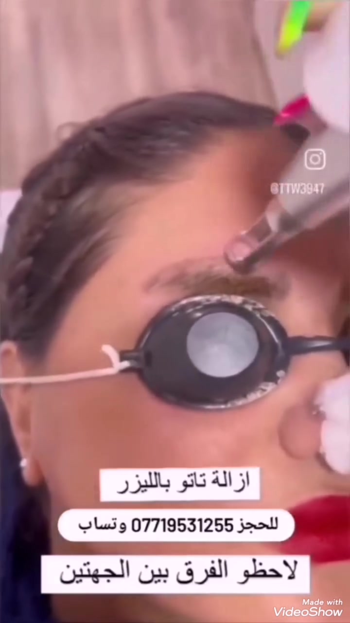 مسح تاتو حواجب ووشم بااحدث أجهزة الليزر وبدون أي اثر وبضمان للحجز *********** وتساب كركوك
