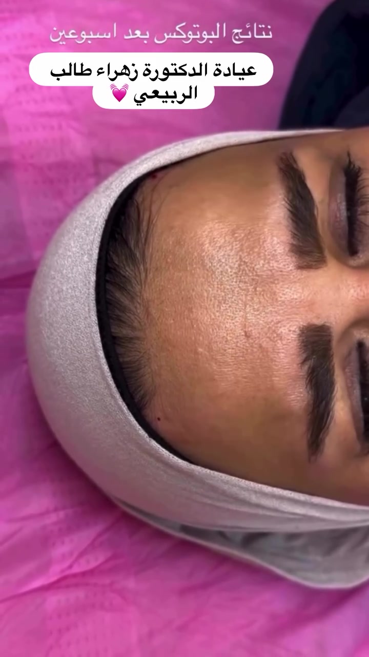 منو عنده هيج خطوط وضايج منها 

ضروري لمن تبلش عندك هيج خطوط تسويها لان اذا ماسويتهه وتركتهه تطبع ويبقى الخط موجود 💐💐 

البوتوكس هو الحل !!🌸🤍🤍🤍 

من احلى الاجراءات الي ممكن نشوف عليها فرق والمراجع او المراجعة يحبوها لان نتيجة سريعة 
❤️
 
العنوان المسيب شارع البلدية
للحجز والاستفسار فقط واتساب مسج ***********
