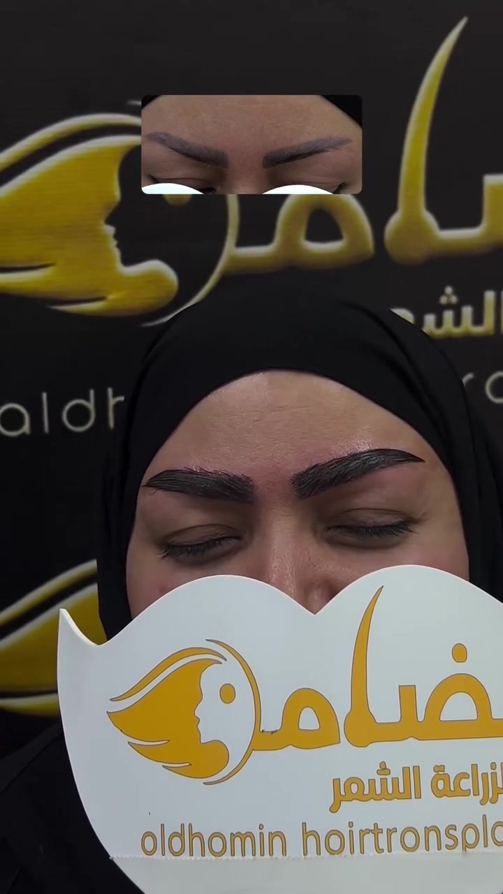 بعد 14يوم للزراعة ✨

لا مبالغة… لا شكل مصطنع…

فقط حاجب طبيعي ينسجم مع ملامح الوجه بكل دقة.

بالضامن… الجمال يبدأ من التفاصيل.⁩⁩

🔷العنوان: 
كربلاء المقدسة: الاسكان _ خلف القنصلية الايرانية _ مجمع العيادة الاولى

***********

بغداد: الاعظمية - ساحة عنتر -مستشفى دجلة الاهلي
***********
#حاجب #زراعة_حاجب 
#كربلاء #بغداد 
#اكسبلورexplore⁩⁩⁩⁩
