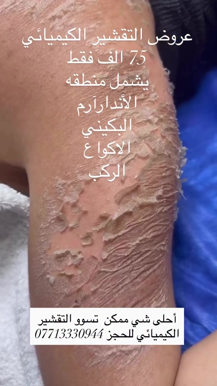 #العرض لفتره محدوده الى نهايه شهر ال٧ 

للحجز دايركت أو *********** واتس
