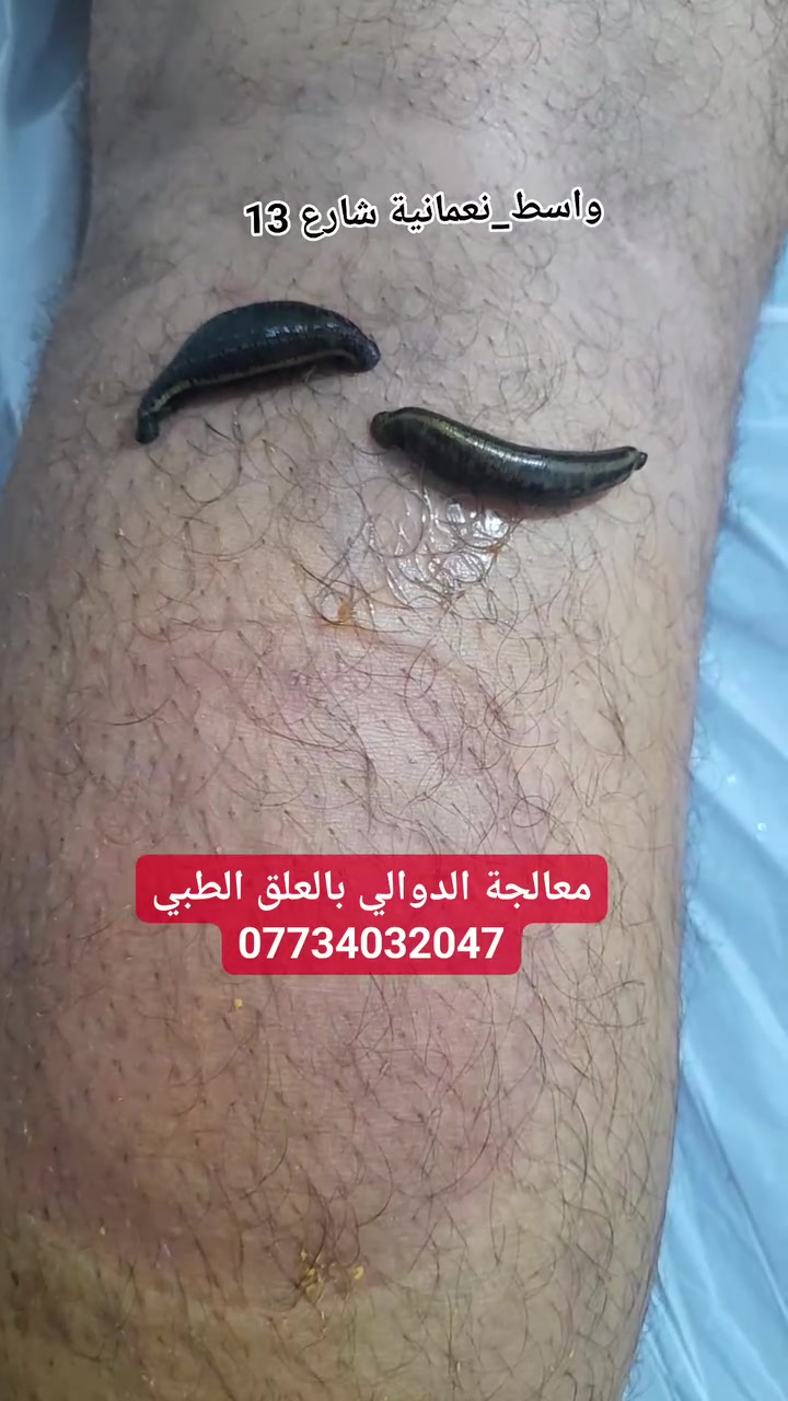 🔴 معالجة الدوالي بالعلق الطبي 🔴

يُستخدم العلق الطبي في بعض ممارسات الطب البديل للمساعدة في تخفيف أعراض الدوالي، وقد يساهم لدى بعض الأشخاص في تحسين تدفق الدم وتقليل الشعور بالثقل والانزعاج في الساقين، وذلك بعد تقييم الحالة واختيار العلاج المناسب.

📍 العنوان: محافظة واسط – قضاء النعمانية – شارع 13 – مقابل صيدلية علاء حسين كريم.
👩‍⚕️ يوجد كادر نسائي للنساء وكادر رجالي للرجال.
📞 للحجز والاستفسار: ***********

#الحجامة_النسائية #العلق_الطبي #الدوالي #الطب_البديل #الحجامة #واسط #النعمانية #آلام_الساقين #العلاج_الطبيعي #الصحة
 #الجميع 
 #متابعين 
 #اشارة 
 #الكل
 @إشارة
