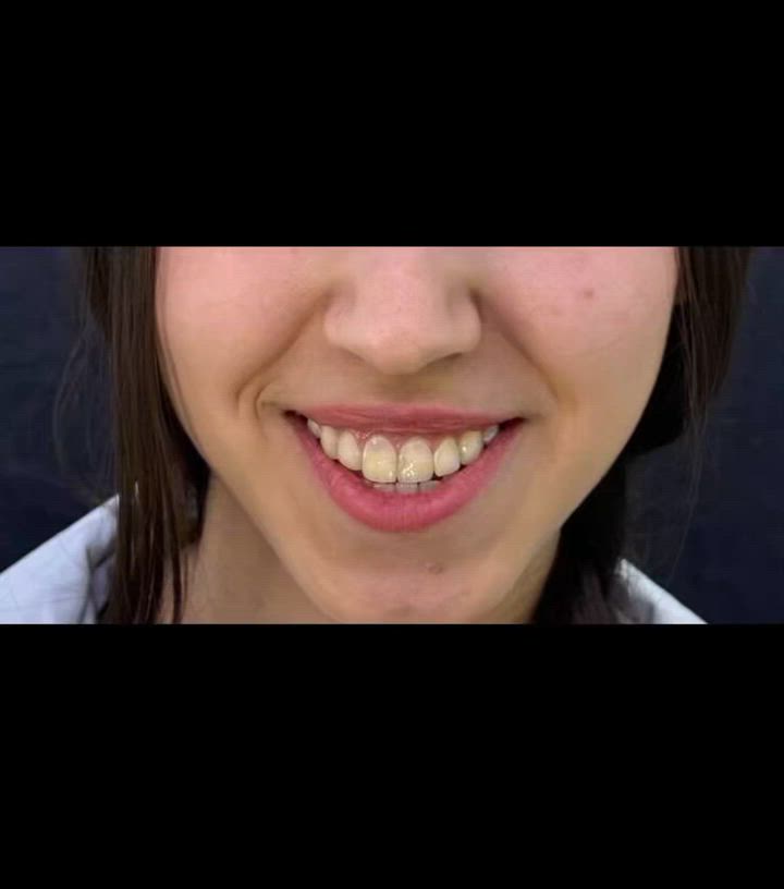 تقويم الأسنان صار أقرب عليكم! ابتسامة مرتبة وجميلة بأحدث طرق التقويم وبمتابعة طبية مميزة. احجزوا موعدكم الآن."

للاستفسار الاتصال على الرقم ***********

العنوان #الطوبجي_مقابل_كوكتيل_البركة
