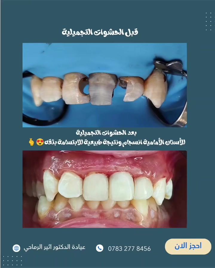 "لأن الابتسامة تستحق الإتقان" 
حشوات تجميلية ضوئية للأسنان الأمامية... تناغم طبيعي، ودقة في كل تفصيل. 🦷✨

 (عيادة الدكتور أثير حليم الرماحي) 

☎️ للحجز والاستفسار ***********
او مراسلة الصفحة

📍 الموقع: 
الديوانية- قضاء عفك/شارع الأطباء قرب صيدلية أكرم البديري بناية الدكتور مهند علي الجبوري الطابق الثاني

#ابتسامتك_تستحق_الأفضل
#حشوات_تجميلية_حشوات_جذور_تركيب_اسنان_ثابتة_ومتحركة_تبييض_اسنان_بالليزر_ابتسامة_المشاهير #دكتورأسنان #اكسبلورexplore #الديوانية_قضاء_عفك
