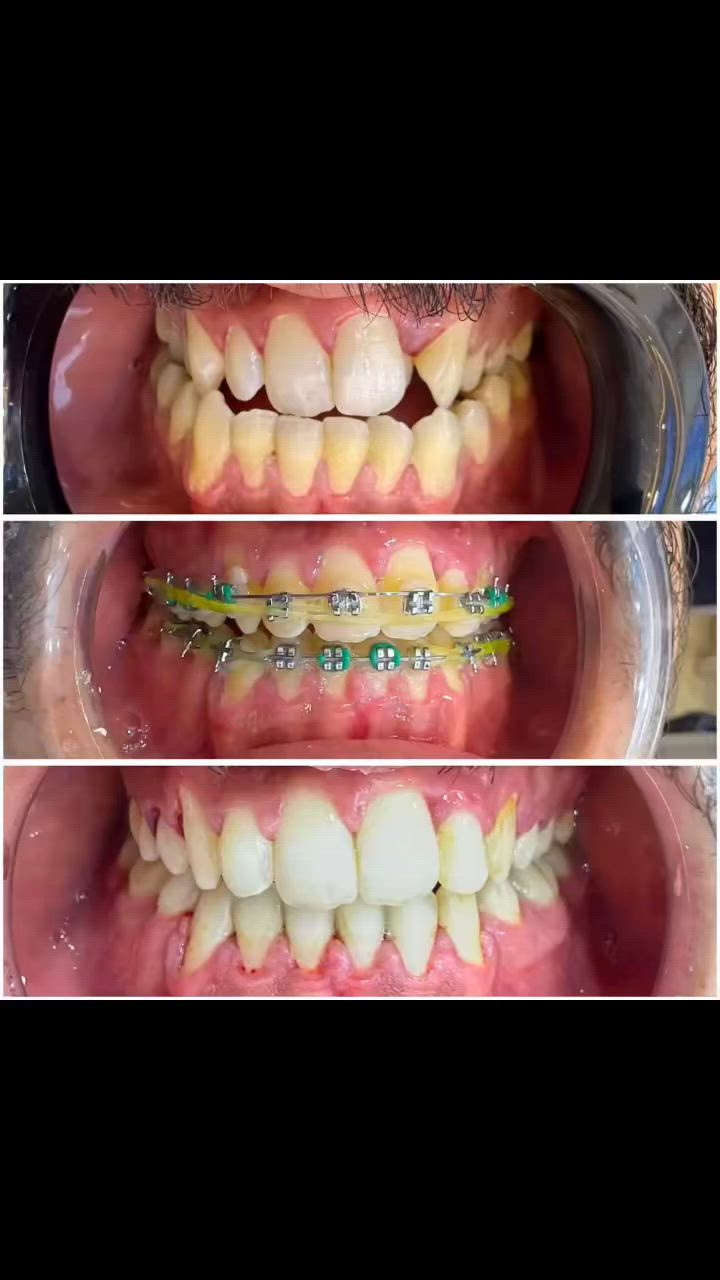 🦷✨ حالة تقويم أسنان ✨🦷

تمت متابعة الحالة ومعالجة تراكب الأسنان بنجاح،
على الرغم من عدم وجود مسافة كافية في الفك 👌

على يد الدكتورة ميس ناصيف
أخصائية تقويم الأسنان 🤍✨

📍 الموقع: العزيزية – شارع الخليج – جانب البوابة
📞 الهاتف: ***********

مستشفى روح الحياة الأهلي
قسم الأسنان 🦷
