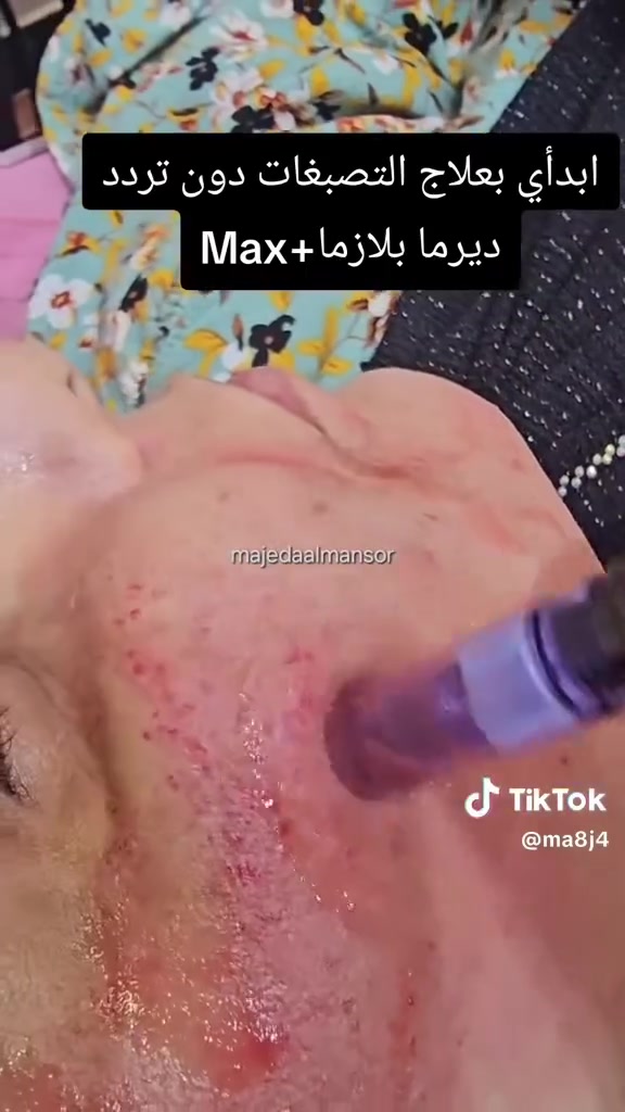 "بشرتكِ هي واجهتكِ، والأمانة في الشغل هي سر تميزنا! ✨
مع الدكتورة ماجدة المنصور Jojo Alnabeel  في مجمع سماء الحسينيه الطبي ، نضمن لكِ نتائج حقيقية ودقيقة بأحدث تقنيات البلازما، تقطيع الألياف، والديرما بن .. لمسات تعيد لبشرتكِ نضارتها وتخلصكِ من آثار الندبات والتصبغات. 🌸
​ولا تنسين، دلالنا إلكِ مستمر.. زيارتكِ لنا تعني هدية مميزة "#سحبة_حظ" بانتظاركِ مع كل فاتورة! 🎁😍

✅ العنوان /بغداد /الحسينيه /مقابل السوق الكبير /مجاور مرطبات العذراء /مجمع سماء الحسينيه الطبي/ طابق ثاني /قسم التجميل والليزر والصالون للحجز والاستفسار ***********
Jojo Alnabeel 
مجمع سماء الحسينيه الطبي
