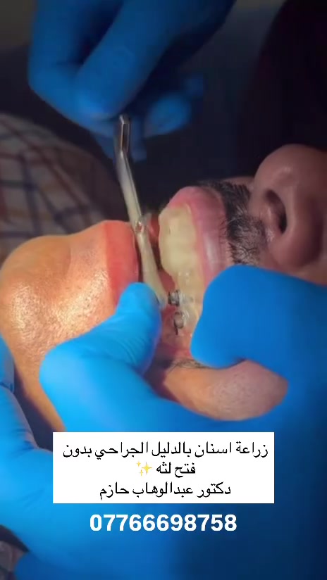 زراعه الاسنان الي الكل يخاف منها صارت جدا سهله بجهاز الدليل  الجراحي وبدون فتح لثه 

بأيد  الدكتور المبدع #عبدالوهاب حازم 
رقم الحجز :*********** 
العنوان الحود الشارع العام 
يتوفر نظام التقسيط لتسهيل العلاج

