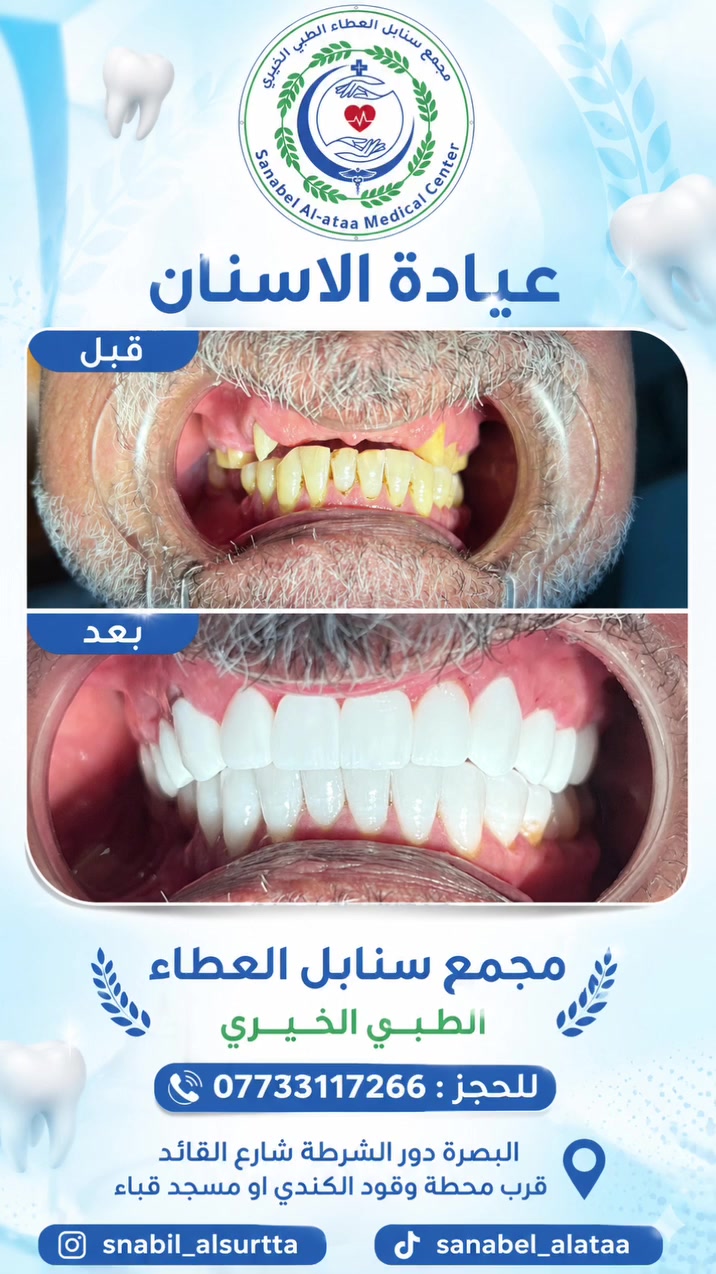 الفرق واضح... والنتائج تتحدث عن نفسها.
ابتسامة جديدة تعني ثقة أكبر وحياة أجمل.
 في عيادة الاسنان 🦷  نحرص على تقديم رعاية متكاملة باستخدام أحدث التقنيات لتحقيق أفضل النتائج.

📍 البصرة – دور الشرطة، شارع القائد، قرب محطة وقود الكندي أو مسجد قباء.

📞 ***********

مجمع سنابل العطاء الطبي الخيري
ابتسامتكم... رسالتنا. 🌿🦷
