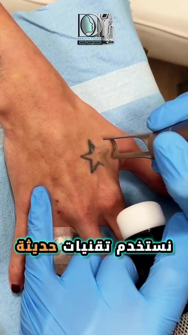 الخبر الحلو... الحل موجود!🫰🏻🔥
✨ زورونا الآن واحصلوا على معاينة مجانية من قبل الدكتور مسلم المسعودي لتقييم الحالة ووضع الخطة المناسبة لإزالة التاتو بأحدث تقنيات الليزر.
✔️ إزالة تاتو الحواجب ✔️ إزالة تاتو الجسم ✔️ جلسات آمنة وفعالة ✔️ متابعة بإشراف طبي
💫 خلي بداية التغيير اليوم... واسترجع مظهرك الطبيعي بثقة أكبر.
📞 للحجز والاستفسار: ***********
#عيادات_دول_للتجميل  #إزالة_التاتو #تاتو_الحواجب #كربلاء #عيادات
