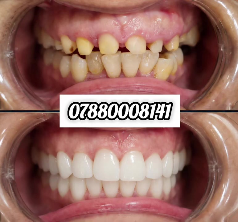 للتواصل واتساب:
***********
#اسنان #تجميل #ابتسامة #زراعة #عيادات
