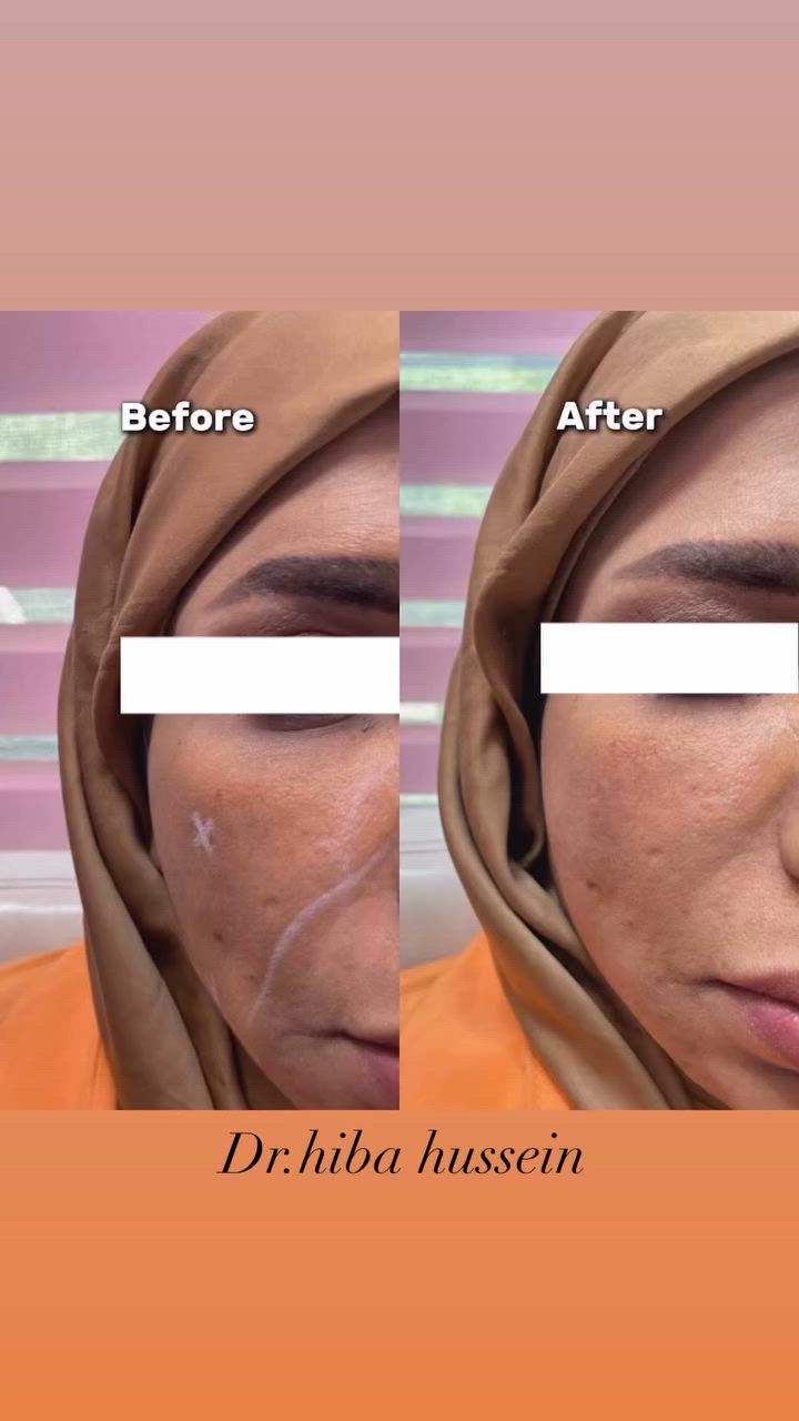 السلام عليكم
تتواجد الدكتورة هبة حسين داخل عيادة سنايا في شارع كفاءات السيدية (شارع كنانة) لتقديم خدمات التجميل اللاجراحي:
💉 حقن الفيلر�💉 حقن البوتوكس�💉 تحديد وإبراز ملامح الوجه�💉 علاج الخطوط والتجاعيد
بأسعار رمزية ومناسبة لفترة محدودة.
📞 للحجز والاستفسار يرجى التواصل مسبقاً وحجز موعد قبل المراجعة ***********
أهلاً وسهلاً بكم 🌷
