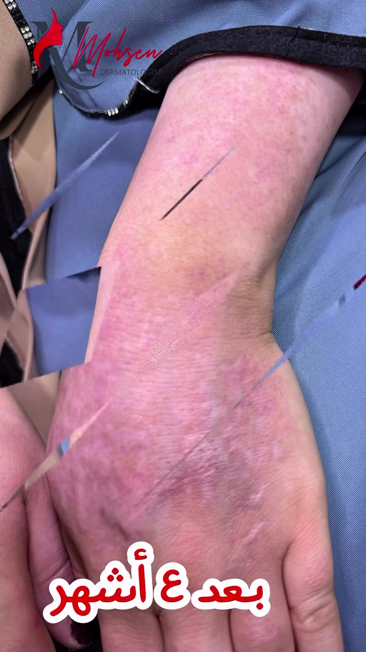 عيادة الامراض الجلديه والتجميل                 
                  الدكتور محمد محسن        
      اختصاصي الامراض الجلديه والتناسليه.                               #دكتوراه(بورد عربي).  
 #Mohamed Mohsen, MD l
اختصاص جراحةوتجميل الجلد   والليزر-بلازما-ميزو-تقشير كيميائي-بوتكس. 
#دبلوم عالي تخصص دقيق في تطبيقات الليزر الطبيه والبايلوجيه.
الرمادي -شارع الاطباء-مجاور صيدلية ابن سيناء-للحجز-***********
