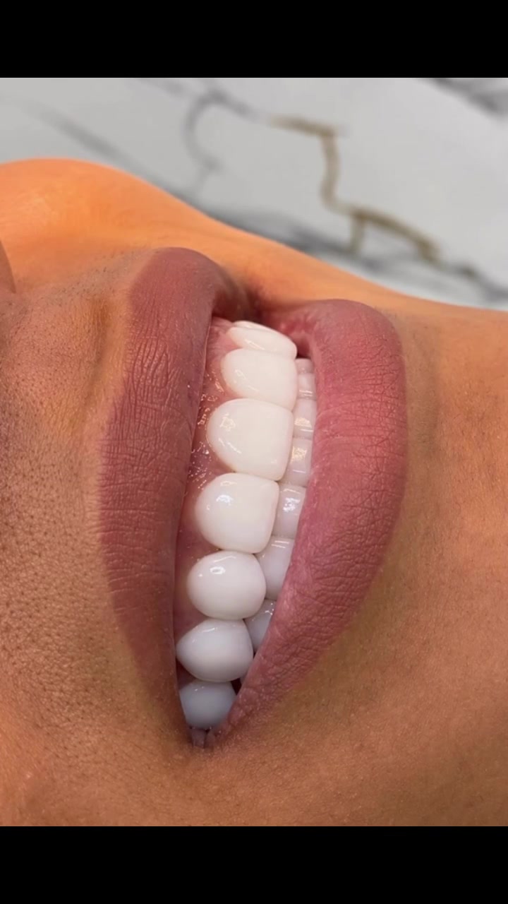 ✨ ابتسامة هوليوودية بأقل سعر! ٢٥٠ الف فقط ✨

😍 Direct Veneer بجودة عالية ولمسة طبيعية تعطيك ابتسامة ناصعة ومتناسقة.

🔥 عرض خاص لفترة محدودة
💥 السعر صدمة: 250 ألف دينار فقط! 💥

✔️ تحسين شكل الأسنان الأمامية
✔️ إغلاق الفراغات البسيطة
✔️ تصحيح الكسور والتصبغات
✔️ إنجاز سريع داخل العيادة

📍 عيادة الدكتورة آية طه
***********
📩 للحجز والاستفسار راسلونا على الخاص أو اتصلوا بنا.

العرض يشمل الحالات المناسبة للـ Direct Veneer بعد الفحص السريري

