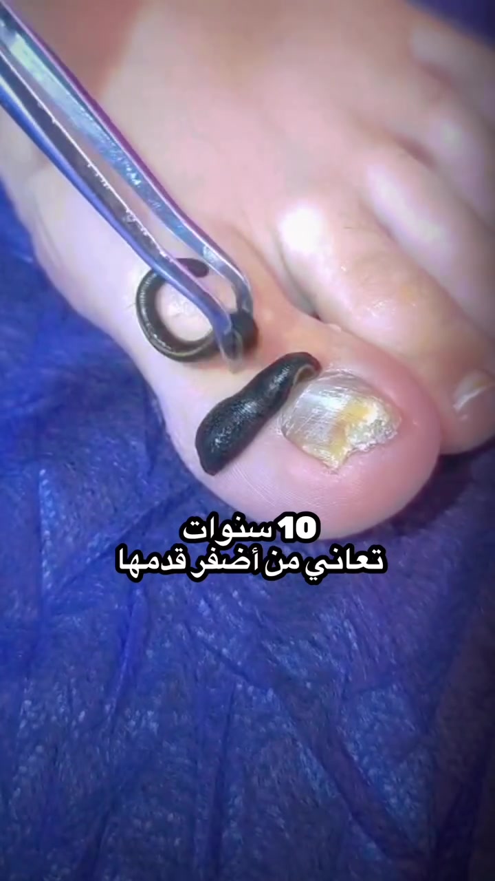عشر سنوات من الألم… مو يوم، ولا شهر… عشر سنوات كاملة!

كانت تعاني من ظفر متحجر، متغير اللون، وألم يرافقها بكل خطوة.

وصلت لمرحلة صارت تشتري أحذية أكبر من قياسها حتى تخفف الوجع، وحتى قص الظفر كان بالنسبة إلها معاناة حقيقية.

راجعت أكثر من طبيب، وكانت تسمع نفس الجواب كل مرة:

“الحل… عملية.”

لكن خوفها من العملية خلاها تأجل العلاج سنة بعد سنة، إلى أن قررت تزور وتين العافية وتبدأ أول خطوة بالعلاج.

في هذا الفيديو وثقنا أول جلسة، وإن شاء الله راح نتابع حالتها جلسة بعد جلسة، ونشارككم تطوراتها بكل أمانة.

🤲 نسأل الله أن يكتب لها الصحة والعافية
——————————————-
وتين العافية
للطب التكميلي الشمولي

💥 الحجامة بأنواعها
💥 العلاج بوخز الإبر الصينية
💥 العلاج بدودة العلق
💥 العلاج بلسع النحل
💥 العلاج بالتغذية
💥 التأهيل الحركي

📍 العنوان:
قضاء خانقين
حي المعلمين
قرب جامع كافية

خبيرة الطب التكميلي الشمولي
خريجة المعهد الكندي الدولي
خبيرة في المكملات الغذائية

📱 للتواصل عبر واتساب:
***********

#فطريات_الأظافر #العناية_بالقدم #العلق_الطبي #وتين_العافية #الطب_التكميلي
