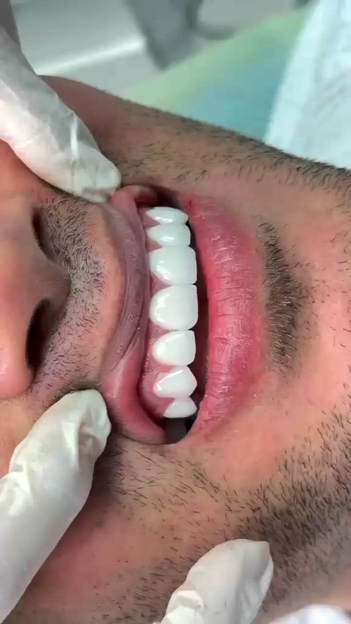 ✨ ابتسامتك أجمل مع تراكيب الأسنان الحديثة ✨

هل تعاني من أسنان مفقودة أو متضررة؟
في مركزنا لطب الأسنان نقدم أحدث أنواع تراكيب الأسنان الثابتة والمتحركة بأعلى جودة وأفضل النتائج التجميلية.

🦷 تركيبات الزيركون الألماني
🦷 تركيبات البورسلان عالية الجودة
🦷 تصميم طبيعي ولون مطابق للأسنان
🦷 بإشراف أطباء متخصصين وخبرة متميزة

✔️ استشارة وفحص أولي
✔️ أسعار مناسبة وخطط علاج مرنة
✔️ عناية فائقة لابتسامة تدوم طويلاً

📍 زوروا مركزنا واستعيدوا ثقتكم بابتسامتكم اليوم.

📞 للحجز والاستفسار:

العنوان / النجف الاشرف _ المناذرة _ الشارع العام _ قرب مستشفى
 المناذرة _عمارة الحاج ابو نبيل جانب صيدلية الأصالة
 للحجز والأستفسار / ***********
الساعه 9:00 صباحا الساعه 1:00 ظهرا من الساعه 3:00 ظهرا الى الساعه 9:00 ليلا ًَ
