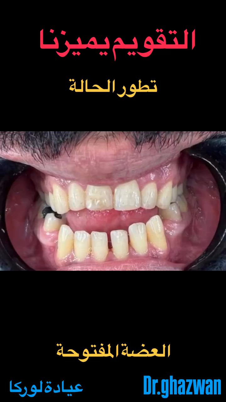 التقويم يميزنا من احد النتائج و التطورات من اعقد و اصعب الحالات تقدم الفك السفلي و العضة المفتوحة حيث يذكر ان المريض قد قام سابقا بالسفر خارج العراق و اجراء عملية قص الفك و لكن بعد مدة رجع نفس الوضع و جاء لعيادتنا و ابتداءنا معالجة من جديد و مستمرين حتى النهاية… علاج جميع الحالات الصعبة و المستعصية نتائج مضمونة طرق علمية متقنة خبرة مميزة طبية متمكنة لافضل الطرق للعلاج… دكتور غزوان مزهر بغداد الكرخ نفق الشرطة بداية شارع الاطباء عيادة لوركا فوق صيدلية كنز النفق متوفر واتس *********** #تقويم_الأسنان_والفكين #تقويمالأسنان #تقويم_الأسنان_بأنواعه #تقويم_الشفاف_للأسنان #تقويم_الأسنان_قبل_وبعد @تقويم_الاسنان @تقدم_الفك_السفلي @العضة_المعكوسة
