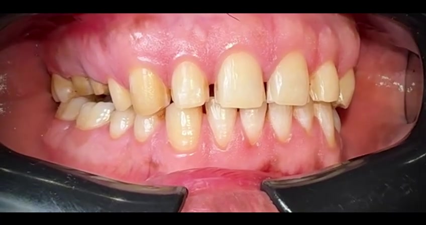 تغيير شكل الاسنان حسب القياسات التجميلية.

عيادة د.عمار عزيز لطيف 👨‍⚕️💗
بغداد / رحمانية الشعله / عمارة الوليد 
للإستفسار الاتصال على 
***********
***********
#عيادة#اسنان
