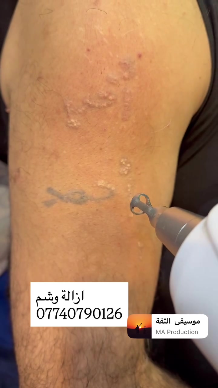 ازالة وشم  مع كتاب رسمي. وأنسب أسعار
ميسان. ابورمانه قرب محمودالكعبي 

***********

ابوجنه 💈
