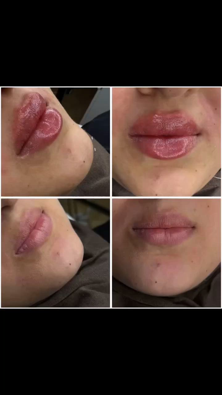 💉✨ سر الجمال بالتفاصيل الصغيرة ✨

فيلر مدروس بعناية يمنحكِ ملامح أكثر تناسقًا، إشراقة أجمل، ونتيجة طبيعية تخطف الأنظار على يد الدكتورة ميرم عنقة🤍👌

لأن الجمال الحقيقي هو اللي يبرز ملامحك… مو يغيّرها ✨

📍 الموقع: العزيزية – شارع الخليج – جانب البوابة
📞 الهاتف: ***********

مستشفى روح الحياة الأهلي
قسم التجميل ✨
