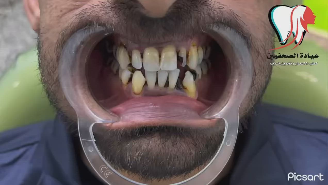 ١: معالجة الاسنان المتضررة 
٢: معالجة اللثة 
٣: ازالة بقاية الاسنان التالفة 
٤: تعويض الاسنان المفقودة 
٥: استخدام تقنية الطباعة الاليكترونية 
٦: تغليف الاسنان بالزاركون الاماني 
النتيجة 🔥🔥✔️

📍العنوان البلديات / الصحفيين على يمين افران ومعجنات عسل ( مقابل الساحات الترابية )

للاستفسار والحجز واتساب-فايبر-تيليجرام:📞 
دكتور الاسنان ازهر الكناني 👨🏻‍⚕️🦷  ***********
دكتورة التجميل 👩🏻‍⚕️🎀 ***********
او مراسلتنا على الخاص
‏INSTAGRAM➡️ @dr_za91
‏Facebook ➡️عيادة الصحفيين لتجميل وتقويم وزراعة الاسنان
