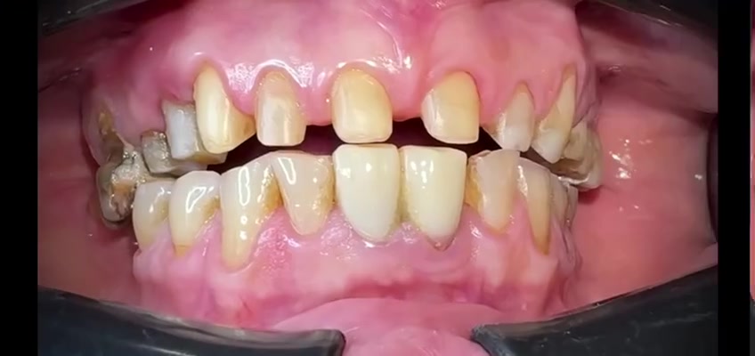معالجة الاسنان, جسور الزركون, الابتسامة المشرقة.

عيادة د.عمار عزيز لطيف 👨‍⚕️💗
بغداد / رحمانية الشعله / عمارة الوليد 
للإستفسار الاتصال على 
***********
***********
