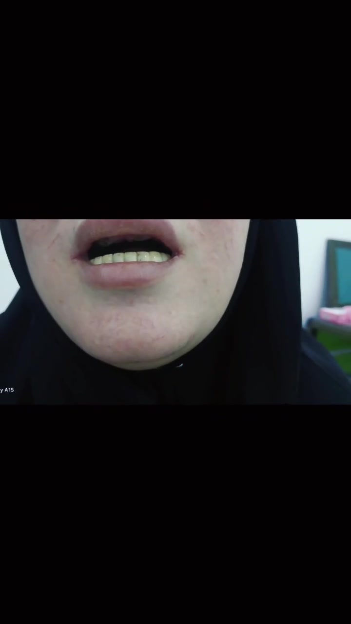 قبل... وبعد ✨🦷
ابتسامة جديدة تعيد لك الثقة والراحة في الأكل والكلام.
في عيادة ومختبر الدكتور مصطفى خضير لزراعة وتجميل الأسنان نُصمم أطقم الأسنان بأحدث التقنيات لتكون مريحة، ثابتة، وبمظهر طبيعي يناسب ابتسامتك.
📍 العنوان: مدينة الصدر – شارع الفلاح – جهة جامع الحسن المجتبى – قطاع 25 – قرب صورة الشهداء.
📞 للحجز والاستفسار: ***********
🎥 شاهد النتيجة بنفسك في هذا الفيديو، واجعل ابتسامتك القادمة أجمل.
#طقم_أسنان #تركيبات_الأسنان #تجميل_الأسنان #زراعة_الأسنان #ابتسامة_هوليوود #قبل_وبعد #أسنان #بغداد #العراق #مدينة_الصدر #ترند #اكسبلور #ريلز #فيسبوك #viral
