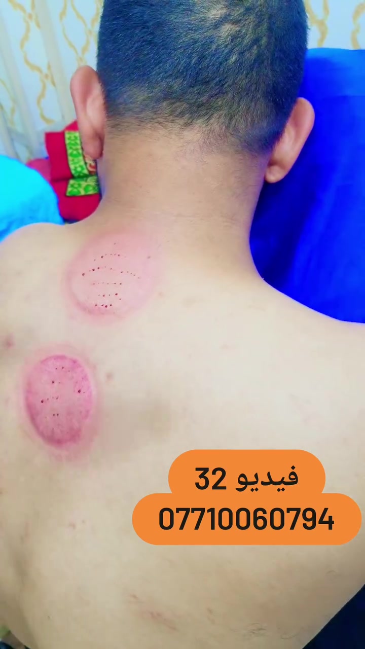 (فيديو جلسة حجامة) 32
العنوان بغداد_الكرخ الجعيفر_شارع الشيخ معروف قرب جامع رشيد دراغ
الحجز او الاستفسار ***********
 #طب_تكميلي #حجامة_رياضية #حجامةالطائي #مركزحجامةالكرخ
