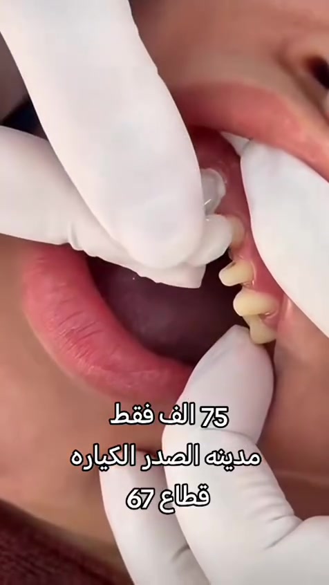 حشوه ضوئية تجميليه ب25 ألف
75 ألف تركيب الزاركون الألماني المدمج بالايماكس 
55 ألف تركيب السيراميك الألماني 
تقويم الاسنان بالتقسيط المريح 
زراعة الأسنان 

فحص ومعاينة مجاني يوميا مع اشعه للاسنان ☺️

عيادة ايفا للتجميل والأسنان 💉🦷
دكتور محمد سعدون 

العنوان #مدينة الصدر الكياره قطاع٦٧ مقابل نادي الجولان

‏‪***********‬‏📞
