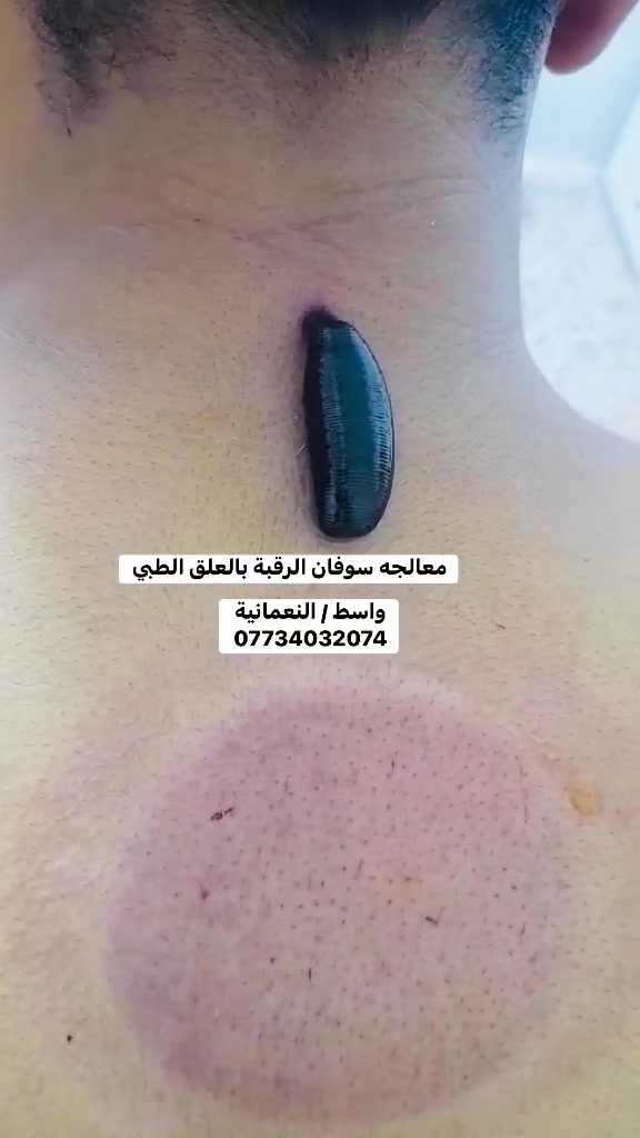 معالجة سوفان الرقبة بالعلق الطبي

إذا كنت تعاني من آلام الرقبة الناتجة عن سوفان الرقبة، فإن العلاج بالعلق الطبي يُستخدم في بعض ممارسات الطب البديل بهدف المساعدة على تخفيف الألم وتحسين الدورة الدموية وتقليل الشعور بالتيبس لدى بعض الأشخاص.

📍 يوجد كادر نسائي و رجالي 
📞 للحجز والاستفسار: ***********

#الحجامة_النسائية #العلق_الطبي #الطب_البديل #سوفان_الرقبة #آلام_الرقبة #واسط #النعمانية #الحجامة #العلاج_الطبيعي #الصحة
