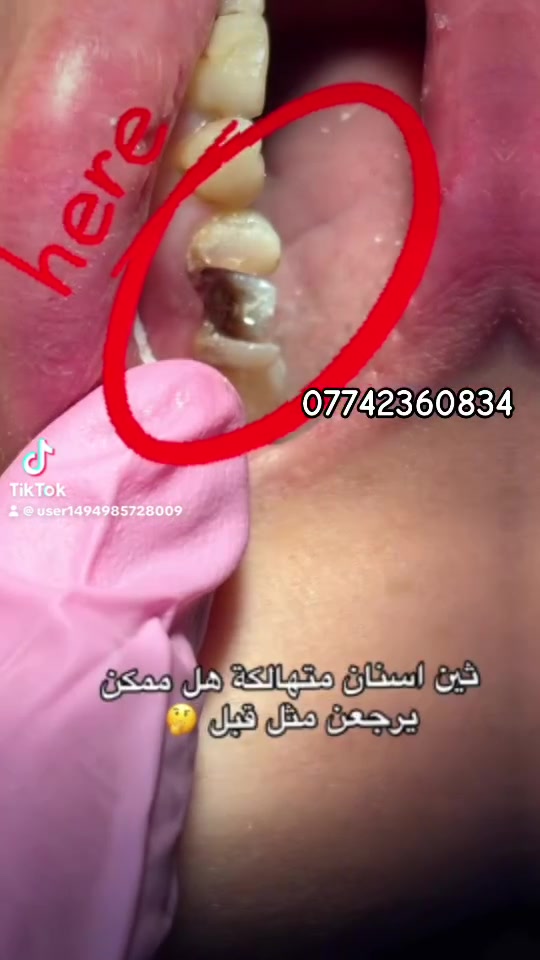 🦷✨ لأن ابتسامتك تستحق الأفضل…
ترميم الأسنان بالحشوات الضوئية يعيد للسن شكله الطبيعي، لونه، ووظيفته بدقة عالية وبدون ما يبين الفرق. 🤍

✔️ مظهر طبيعي
✔️ متانة وقوة
✔️ جلسة سريعة ونتيجة فورية

احجز موعدك واسترجع ابتسامتك بثقة. 🌸
📞 ***********
