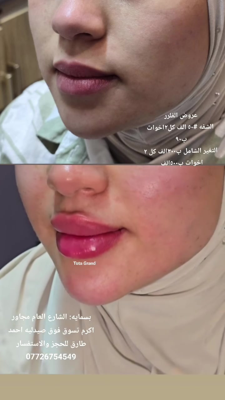 ✨ التغيير الشامل… لأن الجمال تفاصيل ✨
بعياده تــდــــوته كراند 😍😍
والدكتور كريم عبد خلف اخصائي الجلديه والتجميل والليزر 

عرضنا المميز يشمل:
1💉 بوتكس لتجاعيد  الجبهة وحول العين
2💉 ٦ إبر فلر للوجه 
3💉. جلسه  تبيض  وشد 
4💉فلر شفه وتكنيك مرسوم 

كل هذا بسعر خاص:
الآن فقط ٣٩٠ألف 🔥
بدل 600 ألف 

نتائج مرتبة، ملامح متناسقة، ونضارة مشرقة 
العنوان بسمايه الشارع العام مجاور اكرم تسوق فوق صيدليه احمد طارق للحجز والاستفسار ***********

#حقن #فلر #شفه #تصبغات #جلديه #خيوط #ليزر#بوتكس #تبييض #علاج حبوب #تجاعيد #شعر #ميزو #بلازما #هالات
