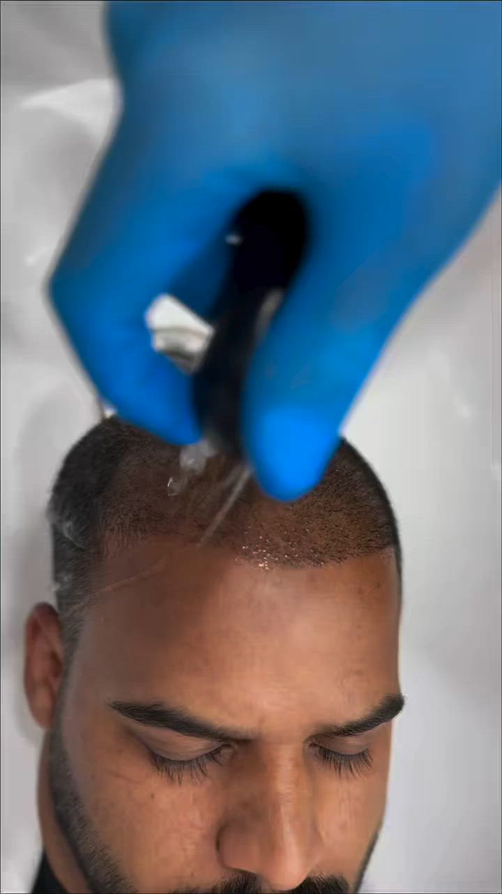 بعد ١٥ يوم بس من زراعة الشعر
مرحلة التقشير  تخلص ☑️
والفروة تبدي تتنفس☑️
والنتيجة تبين نظيفة وطبيعية 👌

هاي مو نهاية الرحلة… هاي البداية الصح لكثافة أقوى وشعر يرجعلك ثقتك خطوة خطوة

كل هذا بفضل خبرة الكادر الطبي 
وتقنيات مدروسة
 تضمن أفضل بداية لرحلة كثافة صحية وطبيعية ترجعلك ثقتك بنفسك🫵🏻🩶

للحجز والاستفسار 
***********
 او زورونا بموقع العياده 🟦 بغداد المنصور شارع الرواد مقابل مرطبات مشمشه

