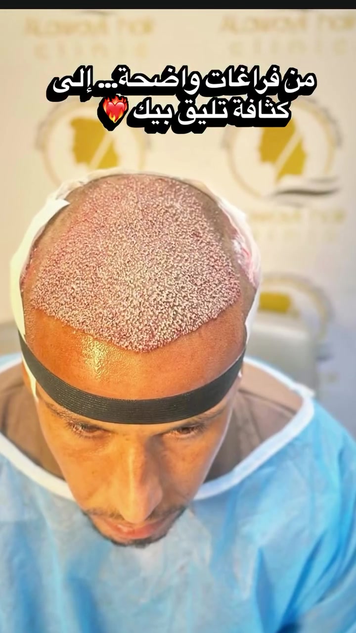 نتيجة ستة اشهر فقط 
علماً ان الشعر يستمر بالنمو لمدة سنه كامله 😍❤️‍🔥

📍 عيادة الأوائل التخصصية لزراعة الشعر – النجف الأشرف
📞 للحجز والاستفسار: ***********
📩 راسلونا أو زورونا لحجز استشارتكم”

#explore #اكسبلور #viral #reels #زراعة_الشعر
