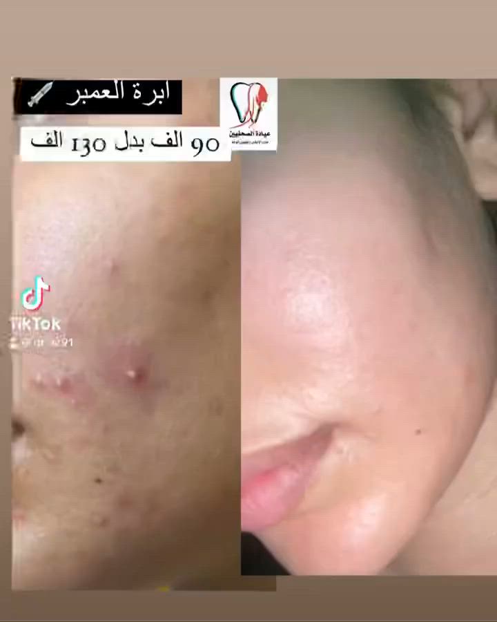 عروض عيادة الصحفيين لطب الاسنان و تجميل الوجه🔥
 
الحجز والاستفسار ع الرقم ***********)

🚩💉أبرة العمبر 90 الف بدل 130 الف 💥💥

💥ميزو نضاره25 الف
💥ميزو تصبغات25 الف
💥توريد شفه25 الف
💥ميزو هالات25 الف
💥ميزو تبييض25 الف  

🚩بكجات النضاره💥

بلازما ماتركس +خلايا جذعيه للشعر 75 بدل ال125💥 
بلازما ماتركس + ميزو فلر+توريد85 الف بدل140 💥
تنظيف بشره + بلازما مفعله 35 بدل ال50الف
بلازما مفعله للشعر + بايوتين 25 الف بدل ال50💥

🚩🚩 عروض الفلر💉🔥🔥 
فلر شفه الكوري 75 الف بدل ال100 الف🔥
وجنات 250 الف مع بكج نضاره مجاناً🔥
تغيير الشامل 500 الف بدل 750 الف 🔥

🚩🚩 عروض البوتوكس 💉☄️🔥
رفع حاجب 45 الف بدل ال75 
بوتوكس تعرق 140 بدل ال200 الف
بوتوكس تجاعيد 100 الف بدل ال150
