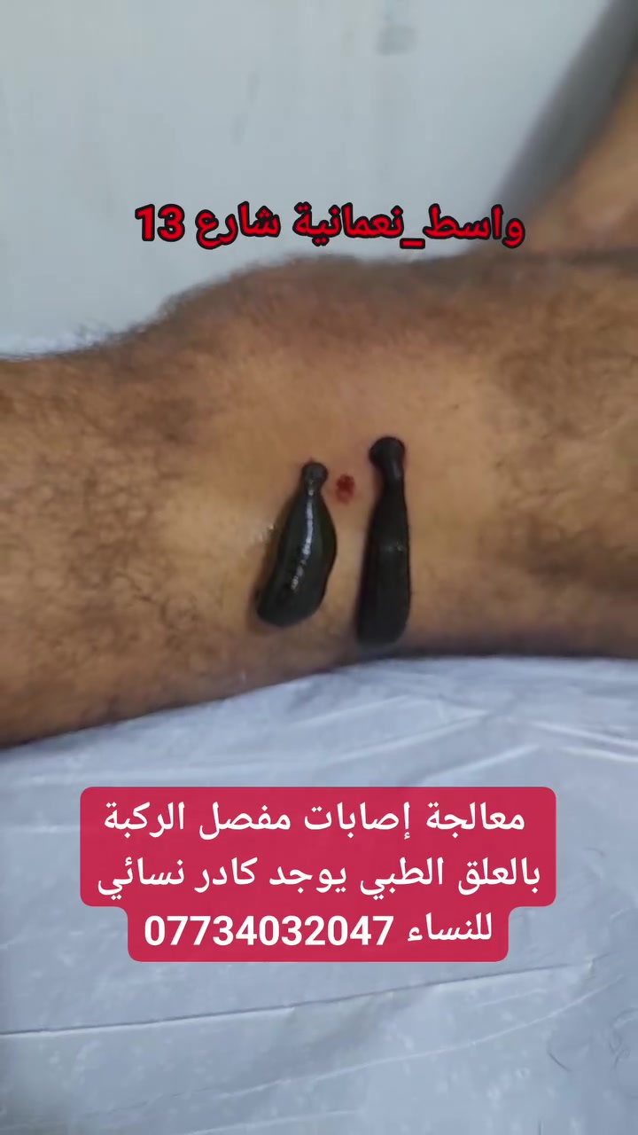 🩺 معالجة إصابات مفصل الركبة بالعلق الطبي

إذا كنت تعاني من آلام مفصل الركبة أو الإصابات الناتجة عن الإجهاد أو النشاط اليومي، فإن العلاج بالعلق الطبي يُستخدم في بعض ممارسات الطب التكميلي بهدف المساعدة في تخفيف الألم وتحسين الدورة الدموية الموضعية وفق تقييم الحالة.

📍 العنوان:
محافظة واسط – قضاء النعمانية – شارع 13 – مقابل صيدلية علاء حسين كريم.

👩 يوجد كادر نسائي للنساء.
👨 يوجد كادر رجالي للرجال.

📞 للاستفسار والحجز:
***********

#العلق_الطبي #الحجامة #الحجامة_النسائية #الطب_البديل #علاج_الركبة #آلام_الركبة #واسط #النعمانية #العراق #الصحة #العلاج_التكميلي #حجامة_واسط #حجامة_النعمانية
 #الجميع 
 #متابعين 
 #اشارة 
 #الكل
 #everyone 
 @أبرز المعجبين
