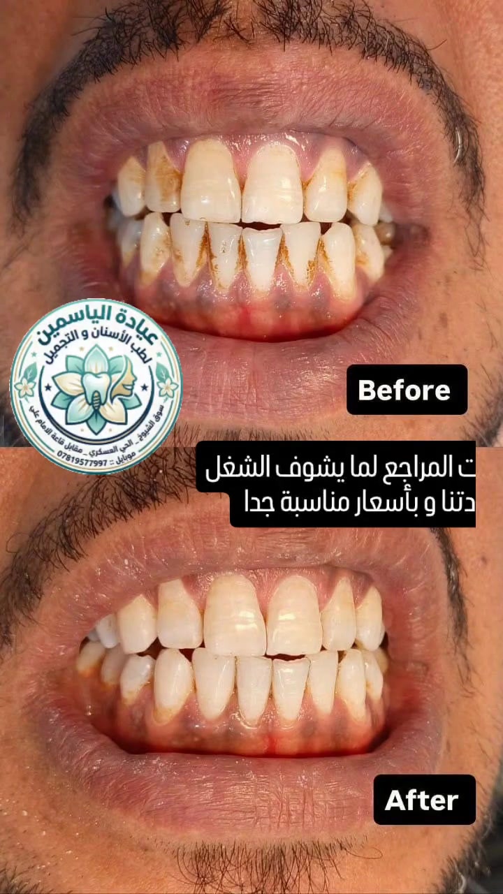 ابتسامة بيضاء بلمسة احترافية! ✨
لا تسمح للبقع والقهوة أن تخفي جمال ابتسامتك. احجز جلستك لتنظيف وتبييض الأسنان في عيادة الياسمين واستعد بريق أسنانك من جديد. 🦷💎
📞 تواصل معنا:***********
سوق الشيوخ حي العسكري مقابل مضيف الإمام علي 

#اكسبلورر #فولو #اكسبلورexplore #تجميل #هاشتاك
