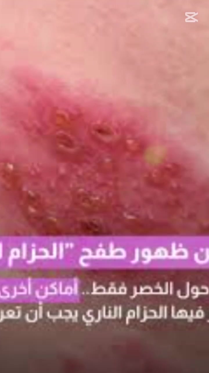 الحزام الناري Herpes Zoster.☠️☠️
أسباب الحزام الناري
ينشط الفيروس غالبًا عند ضعف المناعة أو بسبب:
التقدم في العمر
التوتر والضغط النفسي
الأمراض المزمنة
ضعف جهاز المناعة
التعب والإجهاد الشديد
أعراض الحزام الناري:
*تظهر الأعراض عادة في جهة واحدة من الجسم أو الوجه، ومن أهمها:
الأعراض المبكرة
ألم أو حرقة في الجلد
حكة أو وخز
حساسية شديدة للمس
الأعراض الرئيسية:
*ظهور طفح جلدي أحمر
*بثور مملوءة بسائل
*ألم شديد يشبه الحرق
*ارتفاع بسيط في الحرارة
*صداع أو تعب عام
أماكن ظهوره:
- الصدر والظهر
ـ الرقبة
ـالوجه
ـحول العين أحيانًا
هل الحزام الناري معدٍ؟
الحزام الناري نفسه لا ينتقل مباشرة، لكن الشخص المصاب قد ينقل فيروس الجدري المائي لشخص لم يُصب به سابقًا، خاصة عند ملامسة البثور.
المضاعفات
إذا لم يُعالج قد يسبب:
ألمًا عصبيًا طويل المدة
التهابات جلدية
مشاكل في العين إذا ظهر قربها
العلاج
يشمل العلاج:
*أدوية مضادة للفيروسات
*مسكنات للألم
*كريمات مهدئة للحكة
*الراحة وتجنب التوتر
ومن الأدوية المستخدمة أحيانًا Acyclovir تحت إشراف الطبيب.
الوقاية:
"تقوية المناعة
"النوم الكافي
"تقليل التوتر
أخذ لقاح الحزام الناري للكبار عند "الحاجة
الخاتمة::
الحزام الناري من الأمراض الجلدية المؤلمة، لكنه قابل للعلاج إذا تم اكتشافه مبكرًا. الاهتمام بالنظافة والعلاج السريع يساعد على تقليل المضاعفات وتسريع الشفاء.
تحياتي د اسيل سعيد عزيز 🥀🥰 
للتواصل وتساب 🥀 
***********
